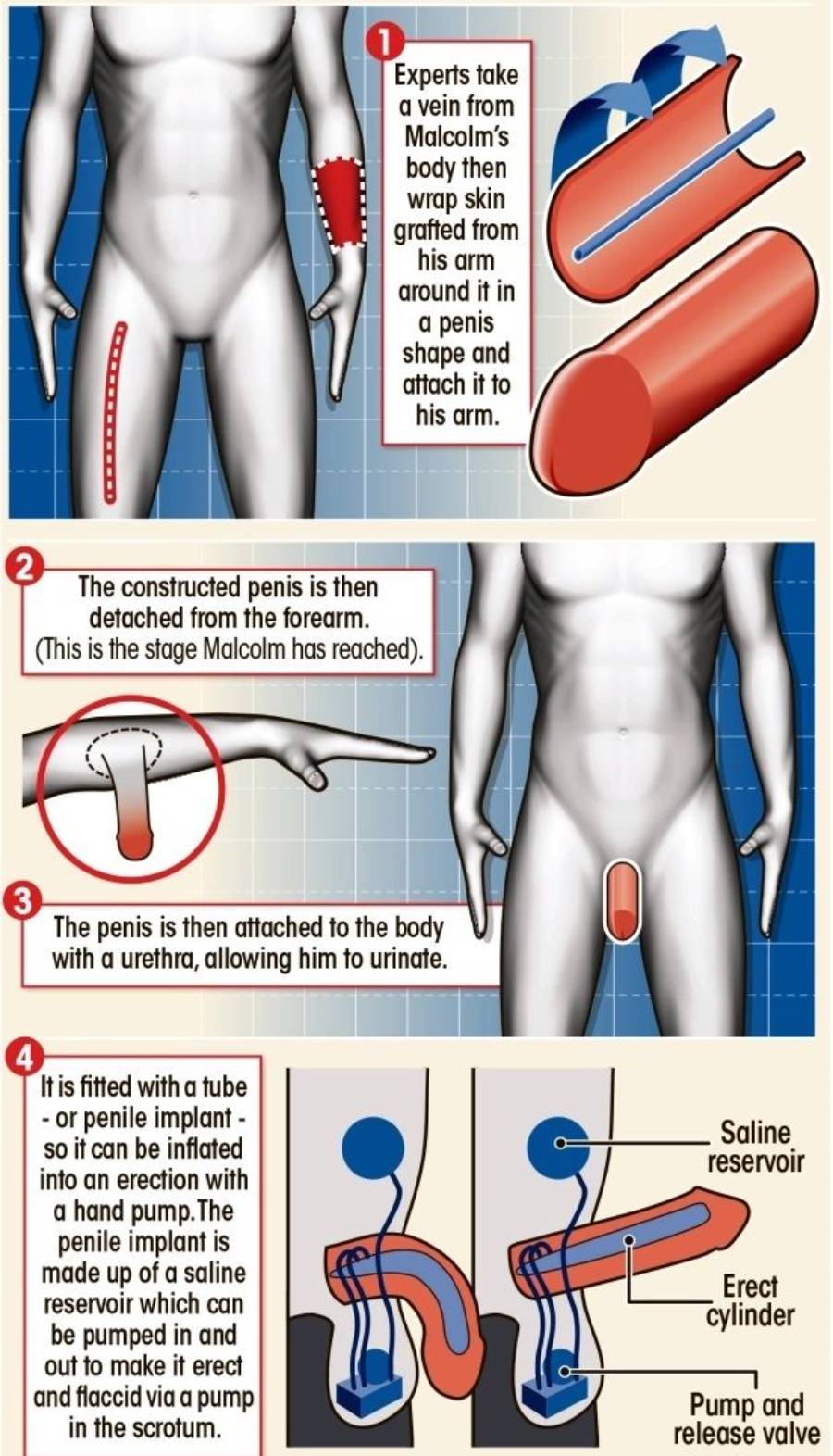 infografia the sun reconstruccion pene